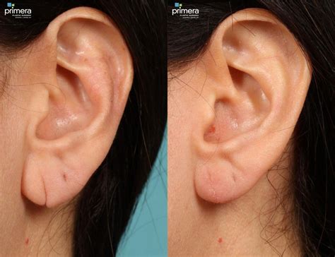 Ear Surgery / Otoplasty .